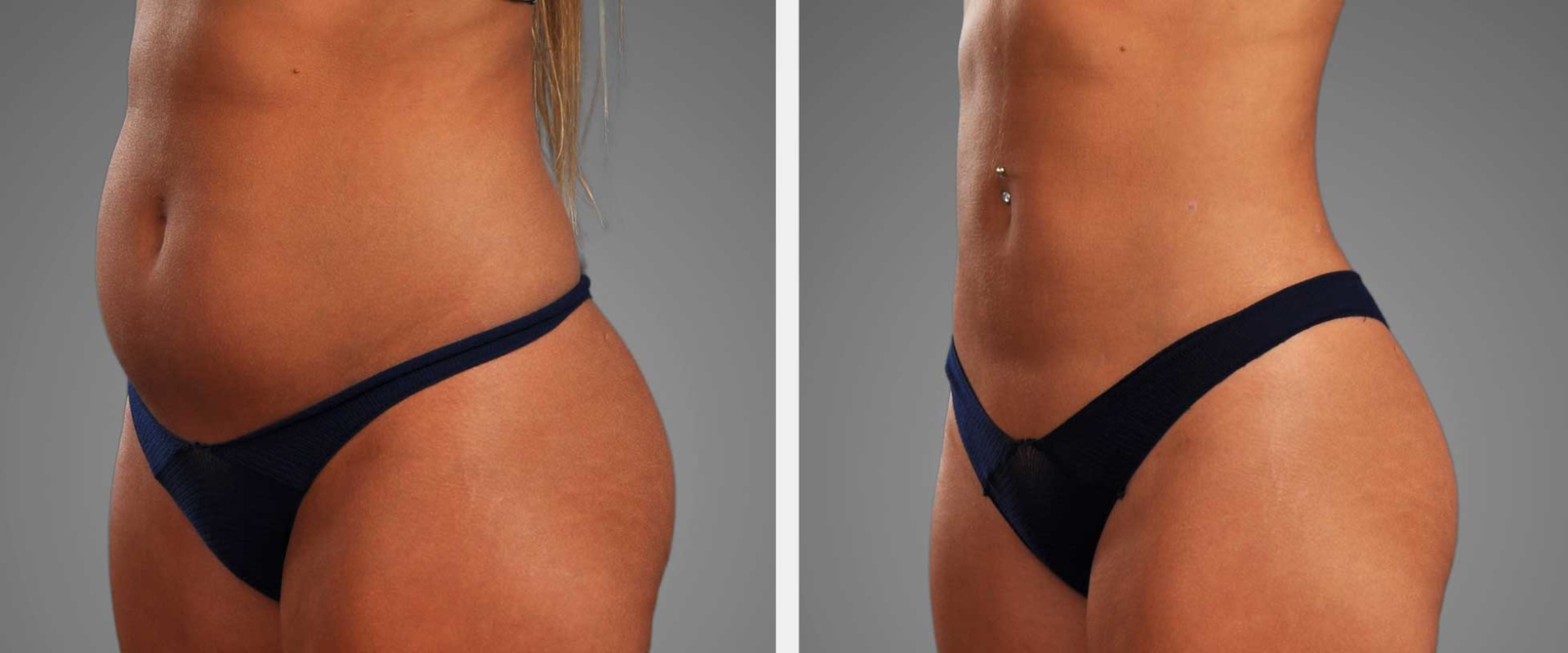 Enhance Your Post-Laser Liposuction Results with Retinol