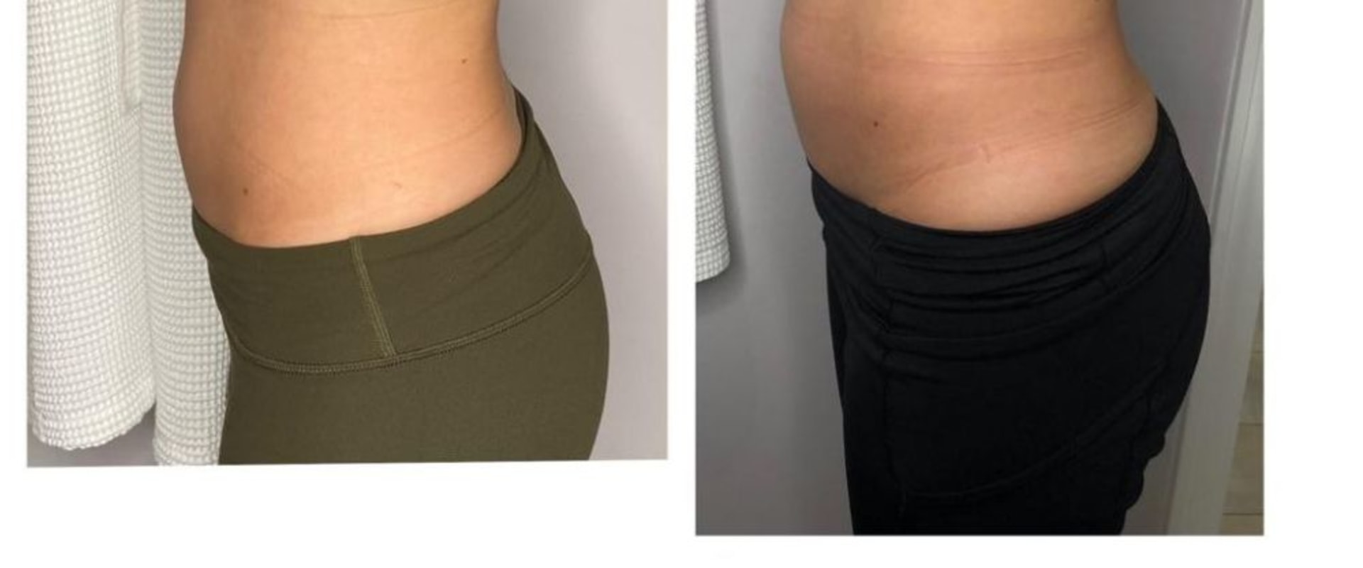 Your Guide To A Slimmer You: The Advantages Of Getting Laser Liposuction At A Trusted Glendale Med Spa Clinic