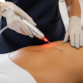 How Laser Liposuction Can Be Used to Target Stubborn Fat Areas