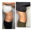 Your Guide To A Slimmer You: The Advantages Of Getting Laser Liposuction At A Trusted Glendale Med Spa Clinic