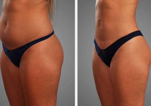 Enhance Your Post-Laser Liposuction Results with Retinol