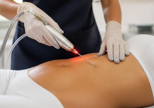 How Laser Liposuction Can Be Used to Target Stubborn Fat Areas