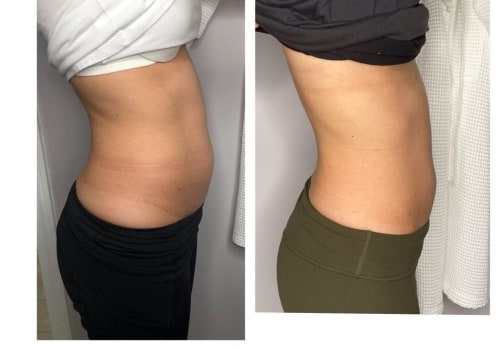 Your Guide To A Slimmer You: The Advantages Of Getting Laser Liposuction At A Trusted Glendale Med Spa Clinic